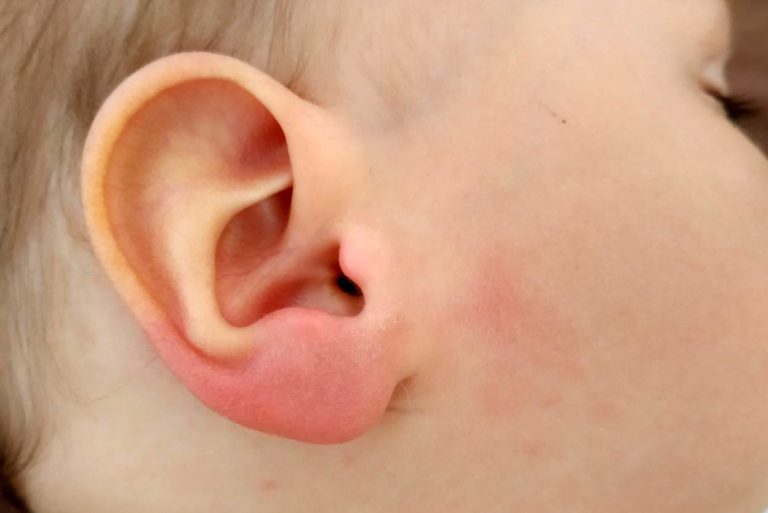 Zeckenbiss beim Baby: Rotes, geschwollenes Ohrläppchen kann Borreliose bedeuten | Rubbelbatz